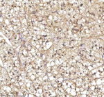 Immunohistochemical staining of RSRC2 using anti-RSRC2 antibody. RSRC2 was detected in a paraffin-embedded section of human adrenocortical adenoma tissue. Heat mediated antigen retrieval was performed in EDTA buffer (pH 8.0, epitope retrieval solution). The tissue section was blocked with 10% goat serum. The tissue section was then incubated with 2 ug/ml rabbit anti-RSRC2 antibody overnight at 4oC. Peroxidase Conjugated Goat Anti-rabbit IgG was used as secondary antibody and incubated for 30 minutes at 37oC. The tissue section was developed using an HRP secondary and DAB substrate.