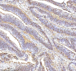 Immunohistochemical staining of RSRC2 using anti-RSRC2 antibody. RSRC2 was detected in a paraffin-embedded section of human colon adenocarcinoma tissue. Heat mediated antigen retrieval was performed in EDTA buffer (pH 8.0, epitope retrieval solution). The tissue section was blocked with 10% goat serum. The tissue section was then incubated with 2 ug/ml rabbit anti-RSRC2 antibody overnight at 4oC. Peroxidase Conjugated Goat Anti-rabbit IgG was used as secondary antibody and incubated for 30 minutes at 37oC. The tissue section was developed using an HRP secondary and DAB substrate.