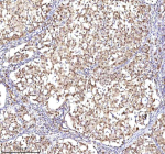 Immunohistochemical staining of RSRC2 using anti-RSRC2 antibody. RSRC2 was detected in a paraffin-embedded section of human ovary serous carcinoma tissue. Heat mediated antigen retrieval was performed in EDTA buffer (pH 8.0, epitope retrieval solution). The tissue section was blocked with 10% goat serum. The tissue section was then incubated with 2 ug/ml rabbit anti-RSRC2 antibody overnight at 4oC. Peroxidase Conjugated Goat Anti-rabbit IgG was used as secondary antibody and incubated for 30 minutes at 37oC. The tissue section was developed using an HRP secondary and DAB substrate.