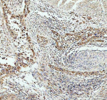 P4HA1 Antibody Human Bladder Cancer IHC. Immunohistochemistry was performed on FFPE human invasive urothelial carcinoma of the bladder with squamous differentiation using P4HA1 Antibody. Heat-induced epitope retrieval was carried out in pH 8 EDTA buffer prior to incubation with the primary antibody at a 1:100 dilution. Bound antibody was detected using an HRP-conjugated goat anti-rabbit IgG secondary antibody with DAB chromogen. Moderate to strong cytoplasmic staining is observed within the neoplastic cells, consistent with elevated P4HA1 expression associated with collagen biosynthesis, extracellular matrix remodeling, and tumor progression. These results demonstrate that this Collagen Biosynthesis Enzyme Antibody is suitable for immunohistochemical detection of P4HA1 in formalin-fixed, paraffin-embedded human bladder carcinoma tissue.