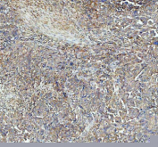 P4HA1 Antibody Human Ovarian Cancer IHC. Immunohistochemistry was performed on FFPE human ovarian cancer tissue using P4HA1 Antibody. Heat-induced epitope retrieval was carried out in pH 8 EDTA buffer prior to incubation with the primary antibody at a 1:100 dilution. Bound antibody was detected using an HRP-conjugated goat anti-rabbit IgG secondary antibody with DAB chromogen. Moderate to strong cytoplasmic staining is observed throughout the neoplastic cells, consistent with elevated P4HA1 expression associated with collagen biosynthesis, extracellular matrix remodeling, and tumor progression. These results demonstrate that this Collagen Biosynthesis Enzyme Antibody is suitable for immunohistochemical detection of P4HA1 in formalin-fixed, paraffin-embedded human ovarian cancer tissue.