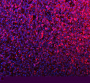 PMEL Antibody for IF / Premelanosome Protein Antibody immunofluorescence analysis in human melanoma tissue. FFPE human melanoma section shows strong red fluorescent cytoplasmic staining in melanoma cells corresponding to premelanosome-associated localization of PMEL (SILV/gp100). The staining pattern appears as punctate vesicular fluorescence within the cytoplasm of tumor cells, consistent with melanosome and premelanosome structures characteristic of melanocytic lineage cells. Nuclei are counterstained with DAPI (blue). Heat mediated antigen retrieval was performed in EDTA buffer (pH 8.0) prior to antibody incubation, followed by detection with DyLight 594-conjugated goat anti-rabbit IgG secondary antibody and visualization by fluorescence microscopy.