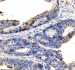 Immunohistochemical staining of DKC1 using anti-DKC1 antibody. DKC1 was detected in a paraffin-embedded section of human colon cancer tissue. Heat mediated antigen retrieval was performed in EDTA buffer (pH 8.0, epitope retrieval solution). The tissue section was blocked with 10% goat serum. The tissue section was then incubated with 2 ug/ml rabbit anti-DKC1 antibody overnight at 4oC. Peroxidase Conjugated Goat Anti-rabbit IgG was used as secondary antibody and incubated for 30 minutes at 37oC. The tissue section was developed using an HRP secondary and DAB substrate.