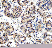 Immunohistochemical staining of DKC1 using anti-DKC1 antibody. DKC1 was detected in a paraffin-embedded section of human breast cancer tissue. Heat mediated antigen retrieval was performed in EDTA buffer (pH 8.0, epitope retrieval solution). The tissue section was blocked with 10% goat serum. The tissue section was then incubated with 2 ug/ml rabbit anti-DKC1 antibody overnight at 4oC. Peroxidase Conjugated Goat Anti-rabbit IgG was used as secondary antibody and incubated for 30 minutes at 37oC. The tissue section was developed using an HRP secondary and DAB substrate.