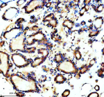 Immunohistochemical staining of TCTN1 using anti-TCTN1 antibody. TCTN1 was detected in a paraffin-embedded section of human thyroid cancer tissue. Heat mediated antigen retrieval was performed in EDTA buffer (pH 8.0, epitope retrieval solution). The tissue section was blocked with 10% goat serum. The tissue section was then incubated with 2 ug/ml rabbit anti-TCTN1 antibody overnight at 4oC. Peroxidase Conjugated Goat Anti-rabbit IgG was used as secondary antibody and incubated for 30 minutes at 37oC. The tissue section was developed using an HRP secondary and DAB substrate.