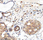 Immunohistochemical staining of Granzyme M/GZMM using anti-GZMM antibody. Granzyme M/GZMM was detected in a paraffin-embedded section of human breast cancer tissue. Heat mediated antigen retrieval was performed in EDTA buffer (pH 8.0, epitope retrieval solution). The tissue section was blocked with 10% goat serum. The tissue section was then incubated with 2 ug/ml rabbit anti-GZMM antibody overnight at 4oC. Peroxidase Conjugated Goat Anti-rabbit IgG was used as secondary antibody and incubated for 30 minutes at 37oC. The tissue section was developed using an HRP secondary and DAB substrate.