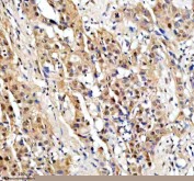 Immunohistochemical staining of PSMD5 using anti-PSMD5 antibody. PSMD5 was detected in a paraffin-embedded section of human bladder cancer tissue. Heat mediated antigen retrieval was performed in EDTA buffer (pH 8.0, epitope retrieval solution). The tissue section was blocked with 10% goat serum. The tissue section was then incubated with 2 ug/ml rabbit anti-PSMD5 antibody overnight at 4oC. Peroxidase Conjugated Goat Anti-rabbit IgG was used as secondary antibody and incubated for 30 minutes at 37oC. The tissue section was developed using an HRP secondary and DAB substrate.