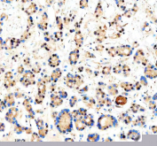 Immunohistochemical staining of CREB3L2 using anti-CREB3L2 antibody. CREB3L2 was detected in a paraffin-embedded section of human thyroid cancer tissue. Heat mediated antigen retrieval was performed in EDTA buffer (pH 8.0, epitope retrieval solution). The tissue section was blocked with 10% goat serum. The tissue section was then incubated with 2 ug/ml rabbit anti-CREB3L2 antibody overnight at 4oC. Peroxidase Conjugated Goat Anti-rabbit IgG was used as secondary antibody and incubated for 30 minutes at 37oC. The tissue section was developed using an HRP secondary and DAB substrate.