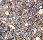 Immunohistochemical staining of SESN2 using anti-SESN2 antibody. SESN2 was detected in a paraffin-embedded section of human colon cancer tissue. Heat mediated antigen retrieval was performed in EDTA buffer (pH 8.0, epitope retrieval solution). The tissue section was blocked with 10% goat serum. The tissue section was then incubated with 2 ug/ml rabbit anti-SESN2 antibody overnight at 4oC. Peroxidase Conjugated Goat Anti-rabbit IgG was used as secondary antibody and incubated for 30 minutes at 37oC. The tissue section was developed using an HRP secondary and DAB substrate.