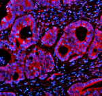 Immunofluorescent staining of SESN2 using anti-SESN2 antibody (red). SESN2 was detected in a paraffin-embedded section of human colon cancer tissue. Heat mediated antigen retrieval was performed in EDTA buffer (pH 8.0, epitope retrieval solution). The tissue section was blocked with 10% goat serum. The tissue section was then incubated with 5 ug/ml rabbit anti-SESN2 antibody overnight at 4oC. Cy3 Conjugated Goat Anti-Rabbit IgG was used as secondary antibody at 1:500 dilution and incubated for 30 minutes at 37oC. The section was counterstained with DAPI nuclear stain (blue). Visualize using a fluorescence microscope and filter sets appropriate for the label used.