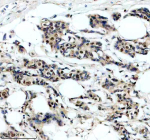Immunohistochemical staining of SRA1 using anti-SRA1 antibody. SRA1 was detected in a paraffin-embedded section of human breast cancer tissue. Heat mediated antigen retrieval was performed in EDTA buffer (pH 8.0, epitope retrieval solution). The tissue section was blocked with 10% goat serum. The tissue section was then incubated with 1: 200 rabbit anti-SRA1 antibody overnight at 4oC. Peroxidase Conjugated Goat Anti-rabbit IgG was used as secondary antibody and incubated for 30 minutes at 37oC. The tissue section was developed using an HRP secondary and DAB substrate.