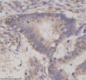 Immunohistochemical staining of OAZ1 using anti-OAZ1 antibody. OAZ1 was detected in a paraffin-embedded section of human colon cancer tissue. Heat mediated antigen retrieval was performed in EDTA buffer (pH 8.0, epitope retrieval solution). The tissue section was blocked with 10% goat serum. The tissue section was then incubated with 2 ug/ml rabbit anti-OAZ1 antibody overnight at 4oC. Peroxidase Conjugated Goat Anti-rabbit IgG was used as secondary antibody and incubated for 30 minutes at 37oC. The tissue section was developed using an HRP secondary and DAB substrate.