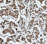 Immunohistochemical staining of DIS3 using anti-DIS3 antibody. DIS3 was detected in a paraffin-embedded section of human breast cancer tissue. Heat mediated antigen retrieval was performed in EDTA buffer (pH 8.0, epitope retrieval solution). The tissue section was blocked with 10% goat serum. The tissue section was then incubated with 2 ug/ml rabbit anti-DIS3 antibody overnight at 4oC. Peroxidase Conjugated Goat Anti-rabbit IgG was used as secondary antibody and incubated for 30 minutes at 37oC. The tissue section was developed using an HRP secondary and DAB substrate.