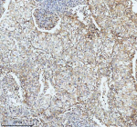 Immunohistochemical staining of SBK1 using anti-SBK1 antibody. SBK1 was detected in a paraffin-embedded section of human lung cancer tissue. Heat mediated antigen retrieval was performed in EDTA buffer (pH 8.0, epitope retrieval solution). The tissue section was blocked with 10% goat serum. The tissue section was then incubated with 2 ug/ml rabbit anti-SBK1 antibody overnight at 4oC. Peroxidase Conjugated Goat Anti-rabbit IgG was used as secondary antibody and incubated for 30 minutes at 37oC. The tissue section was developed using an HRP secondary and DAB substrate.