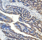 DNMT3A Antibody Colon Cancer Tissue IHC. Immunohistochemistry analysis of FFPE human colon carcinoma tissue using DNMT3A Antibody shows strong nuclear HRP-DAB brown staining in tumor epithelial cells, consistent with localization of DNMT3A / DNA methyltransferase 3 alpha as a nuclear epigenetic regulator. Positive nuclei are distributed throughout malignant glandular structures, while surrounding stromal regions display lower staining intensity. Hematoxylin counterstain provides nuclear contrast and tissue architecture. HIER: heat-mediated antigen retrieval in EDTA buffer (pH 8.0).