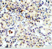 Immunohistochemical staining of PECR using anti-PECR antibody. PECR was detected in a paraffin-embedded section of human liver cancer tissue. Heat mediated antigen retrieval was performed in EDTA buffer (pH 8.0, epitope retrieval solution). The tissue section was blocked with 10% goat serum. The tissue section was then incubated with 2 ug/ml rabbit anti-PECR antibody overnight at 4oC. Peroxidase Conjugated Goat Anti-rabbit IgG was used as secondary antibody and incubated for 30 minutes at 37oC. The tissue section was developed using an HRP secondary and DAB substrate.