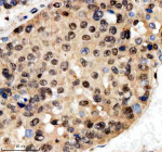 Immunohistochemical staining of SCAF11 using anti-SCAF11 antibody. SCAF11 was detected in a paraffin-embedded section of human liver cancer tissue. Heat mediated antigen retrieval was performed in EDTA buffer (pH 8.0, epitope retrieval solution). The tissue section was blocked with 10% goat serum. The tissue section was then incubated with 2 ug/ml rabbit anti-SCAF11 antibody overnight at 4oC. Peroxidase Conjugated Goat Anti-rabbit IgG was used as secondary antibody and incubated for 30 minutes at 37oC. The tissue section was developed using an HRP secondary and DAB substrate.