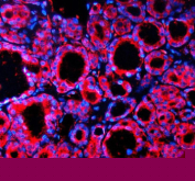 Immunofluorescent staining of SPOCK1 using anti-SPOCK1 antibody (red). SPOCK1 was detected in a paraffin-embedded section of human thyroid cancer tissue. Heat mediated antigen retrieval was performed in EDTA buffer (pH 8.0, epitope retrieval solution). The tissue section was blocked with 10% goat serum. The tissue section was then incubated with 5 ug/ml rabbit anti-SPOCK1 antibody overnight at 4oC. Cy3 Conjugated Goat Anti-Rabbit IgG was used as secondary antibody at 1:500 dilution and incubated for 30 minutes at 37oC. The section was counterstained with DAPI nuclear stain (blue). Visualize using a fluorescence microscope and filter sets appropriate for the label used.