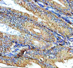 Immunohistochemical staining of NTN4 using anti-NTN4 antibody. NTN4 was detected in a paraffin-embedded section of human endometrial cancer tissue. Heat mediated antigen retrieval was performed in EDTA buffer (pH 8.0, epitope retrieval solution). The tissue section was blocked with 10% goat serum. The tissue section was then incubated with 2 ug/ml rabbit anti-NTN4 antibody overnight at 4oC. Peroxidase Conjugated Goat Anti-rabbit IgG was used as secondary antibody and incubated for 30 minutes at 37oC. The tissue section was developed using an HRP secondary and DAB substrate.