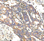 Immunohistochemical staining of STXBP3 using anti-STXBP3 antibody. STXBP3 was detected in a paraffin-embedded section of human colon cancer tissue. Heat mediated antigen retrieval was performed in EDTA buffer (pH 8.0, epitope retrieval solution). The tissue section was blocked with 10% goat serum. The tissue section was then incubated with 2 ug/ml rabbit anti-STXBP3 antibody overnight at 4oC. Peroxidase Conjugated Goat Anti-rabbit IgG was used as secondary antibody and incubated for 30 minutes at 37oC. The tissue section was developed using an HRP secondary and DAB substrate.