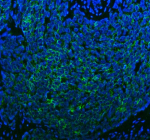 Immunofluorescent staining of SPA17 using anti-SPA17 antibody (green). SPA17 was detected in a paraffin-embedded section of human cervical cancer tissue. Heat mediated antigen retrieval was performed in EDTA buffer (pH 8.0, epitope retrieval solution). The tissue section was blocked with 10% goat serum. The tissue section was then incubated with 5 ug/ml rabbit anti-SPA17 antibody overnight at 4oC. FITC Conjugated Goat Anti-Rabbit IgG was used as secondary antibody at 1:500 dilution and incubated for 30 minutes at 37oC. The section was counterstained with DAPI nuclear stain (blue). Visualize using a fluorescence microscope and filter sets appropriate for the label used.
