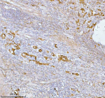 Immunohistochemical staining of SPA17 using anti-SPA17 antibody. SPA17 was detected in a paraffin-embedded section of human rectum adenocarcinoma tissue. Heat mediated antigen retrieval was performed in EDTA buffer (pH 8.0, epitope retrieval solution). The tissue section was blocked with 10% goat serum. The tissue section was then incubated with 2 ug/ml rabbit anti-SPA17 antibody overnight at 4oC. Peroxidase Conjugated Goat Anti-rabbit IgG was used as secondary antibody and incubated for 30 minutes at 37oC. The tissue section was developed using an HRP secondary and DAB substrate.