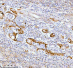 Immunohistochemical staining of SPA17 using anti-SPA17 antibody. SPA17 was detected in a paraffin-embedded section of human rectum adenocarcinoma tissue. Heat mediated antigen retrieval was performed in EDTA buffer (pH 8.0, epitope retrieval solution). The tissue section was blocked with 10% goat serum. The tissue section was then incubated with 2 ug/ml rabbit anti-SPA17 antibody overnight at 4oC. Peroxidase Conjugated Goat Anti-rabbit IgG was used as secondary antibody and incubated for 30 minutes at 37oC. The tissue section was developed using an HRP secondary and DAB substrate.