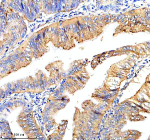 TMEM232 Antibody Human Colon Cancer IHC. Immunohistochemical staining of TMEM232 using anti-TMEM232 antibody. TMEM232 was detected in a paraffin-embedded section of human colon cancer tissue. Heat mediated antigen retrieval was performed in EDTA buffer (pH 8.0, epitope retrieval solution). The tissue section was blocked with 10% goat serum. The tissue section was then incubated with 2 ug/ml rabbit anti-TMEM232 antibody overnight at 4oC. Peroxidase Conjugated Goat Anti-rabbit IgG was used as secondary antibody and incubated for 30 minutes at 37oC. The tissue section was developed using an HRP secondary and DAB substrate.