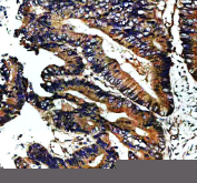 Immunohistochemical staining of NAV1 using anti-NAV1 antibody. NAV1 was detected in a paraffin-embedded section of human colon cancer tissue. Heat mediated antigen retrieval was performed in EDTA buffer (pH 8.0, epitope retrieval solution). The tissue section was blocked with 10% goat serum. The tissue section was then incubated with 2 ug/ml rabbit anti-NAV1 antibody overnight at 4oC. Peroxidase Conjugated Goat Anti-rabbit IgG was used as secondary antibody and incubated for 30 minutes at 37oC. The tissue section was developed using an HRP secondary and DAB substrate.