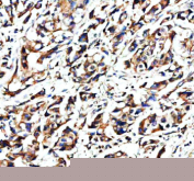 Immunohistochemical staining of NAV1 using anti-NAV1 antibody. NAV1 was detected in a paraffin-embedded section of human breast cancer tissue. Heat mediated antigen retrieval was performed in EDTA buffer (pH 8.0, epitope retrieval solution). The tissue section was blocked with 10% goat serum. The tissue section was then incubated with 2 ug/ml rabbit anti-NAV1 antibody overnight at 4oC. Peroxidase Conjugated Goat Anti-rabbit IgG was used as secondary antibody and incubated for 30 minutes at 37oC. The tissue section was developed using an HRP secondary and DAB substrate.