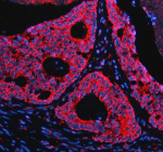 Immunofluorescent staining of NAV1 using anti-NAV1 antibody (red). NAV1 was detected in a paraffin-embedded section of human colon cancer tissue. Heat mediated antigen retrieval was performed in EDTA buffer (pH 8.0, epitope retrieval solution). The tissue section was blocked with 10% goat serum. The tissue section was then incubated with 5 ug/ml rabbit anti-NAV1 antibody overnight at 4oC. Cy3 Conjugated Goat Anti-Rabbit IgG was used as secondary antibody at 1:500 dilution and incubated for 30 minutes at 37oC. The section was counterstained with DAPI nuclear stain (blue). Visualize using a fluorescence microscope and filter sets appropriate for the label used.