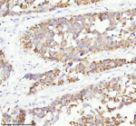 Immunohistochemical staining of RGL3 using anti-RGL3 antibody. RGL3 was detected in a paraffin-embedded section of human liver cancer tissue. Heat mediated antigen retrieval was performed in EDTA buffer (pH 8.0, epitope retrieval solution). The tissue section was blocked with 10% goat serum. The tissue section was then incubated with 2 ug/ml rabbit anti-RGL3 antibody overnight at 4oC. Peroxidase Conjugated Goat Anti-rabbit IgG was used as secondary antibody and incubated for 30 minutes at 37oC. The tissue section was developed using an HRP secondary and DAB substrate.