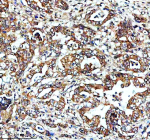 FXN Antibody Pancreatic Adenocarcinoma IHC. Immunohistochemical staining of FFPE human pancreatic carcinoma tissue using anti-FXN antibody demonstrates extensive granular cytoplasmic HRP-DAB brown staining within malignant glandular epithelial cells, consistent with mitochondrial localization of Frataxin / FXN in metabolically active tumor-associated cellular compartments. The observed staining pattern supports the established role of FXN in mitochondrial iron homeostasis, oxidative phosphorylation, and iron-sulfur cluster-associated metabolic pathways. Heat mediated antigen retrieval was performed in EDTA buffer (pH 8.0). The tissue section was blocked with 10% goat serum followed by overnight incubation with 2 ug/ml rabbit anti-FXN antibody at 4Â°C. Peroxidase-conjugated goat anti-rabbit IgG was used as secondary antibody prior to HRP-DAB chromogenic detection.