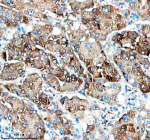 Immunohistochemical staining of PTPRE using anti-PTPRE antibody. PTPRE was detected in a paraffin-embedded section of human liver cancer tissue. Heat mediated antigen retrieval was performed in EDTA buffer (pH 8.0, epitope retrieval solution). The tissue section was blocked with 10% goat serum. The tissue section was then incubated with 2 ug/ml rabbit anti-PTPRE antibody overnight at 4oC. Peroxidase Conjugated Goat Anti-rabbit IgG was used as secondary antibody and incubated for 30 minutes at 37oC. The tissue section was developed using an HRP secondary and DAB substrate.