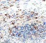 Immunohistochemical staining of PTPRE using anti-PTPRE antibody. PTPRE was detected in a paraffin-embedded section of human liver cancer tissue. Heat mediated antigen retrieval was performed in EDTA buffer (pH 8.0, epitope retrieval solution). The tissue section was blocked with 10% goat serum. The tissue section was then incubated with 2 ug/ml rabbit anti-PTPRE antibody overnight at 4oC. Peroxidase Conjugated Goat Anti-rabbit IgG was used as secondary antibody and incubated for 30 minutes at 37oC. The tissue section was developed using an HRP secondary and DAB substrate.