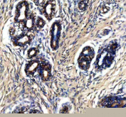 Immunohistochemical staining of PTPRE using anti-PTPRE antibody. PTPRE was detected in a paraffin-embedded section of human breast cancer tissue. Heat mediated antigen retrieval was performed in EDTA buffer (pH 8.0, epitope retrieval solution). The tissue section was blocked with 10% goat serum. The tissue section was then incubated with 2 ug/ml rabbit anti-PTPRE antibody overnight at 4oC. Peroxidase Conjugated Goat Anti-rabbit IgG was used as secondary antibody and incubated for 30 minutes at 37oC. The tissue section was developed using an HRP secondary and DAB substrate.
