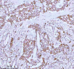 Immunohistochemical staining of using anti-ME3 antibody. ME3 was detected in a paraffin-embedded section of human lung adenocarcinoma tissue. Heat mediated antigen retrieval was performed in EDTA buffer (pH 8.0, epitope retrieval solution). The tissue section was blocked with 10% goat serum. The tissue section was then incubated with 2 ug/ml rabbit anti-ME3 antibody overnight at 4oC. Peroxidase Conjugated Goat Anti-rabbit IgG was used as secondary antibody and incubated for 30 minutes at 37oC. The tissue section was developed using an HRP secondary and DAB substrate.