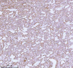 Immunohistochemical staining of using anti-ME3 antibody. ME3 was detected in a paraffin-embedded section of human prostate adenocarcinoma tissue. Heat mediated antigen retrieval was performed in EDTA buffer (pH 8.0, epitope retrieval solution). The tissue section was blocked with 10% goat serum. The tissue section was then incubated with 2 ug/ml rabbit anti-ME3 antibody overnight at 4oC. Peroxidase Conjugated Goat Anti-rabbit IgG was used as secondary antibody and incubated for 30 minutes at 37oC. The tissue section was developed using an HRP secondary and DAB substrate.