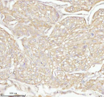 Immunohistochemical staining of TAS2R10 using anti-TAS2R10 antibody. TAS2R10 was detected in a paraffin-embedded section of human cervix squamous cell carcinoma tissue. Heat mediated antigen retrieval was performed in EDTA buffer (pH 8.0, epitope retrieval solution). The tissue section was blocked with 10% goat serum. The tissue section was then incubated with 2 ug/ml rabbit anti-TAS2R10 antibody overnight at 4oC. Peroxidase Conjugated Goat Anti-rabbit IgG was used as secondary antibody and incubated for 30 minutes at 37oC. The tissue section was developed using an HRP secondary and DAB substrate.