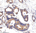 Immunohistochemical staining of MATK using anti-MATK antibody. MATK was detected in a paraffin-embedded section of human colon cancer tissue. Heat mediated antigen retrieval was performed in EDTA buffer (pH 8.0, epitope retrieval solution). The tissue section was blocked with 10% goat serum. The tissue section was then incubated with 2 ug/ml rabbit anti-MATK antibody overnight at 4oC. Peroxidase Conjugated Goat Anti-rabbit IgG was used as secondary antibody and incubated for 30 minutes at 37oC. The tissue section was developed using an HRP secondary and DAB substrate.