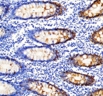 Immunohistochemical staining of Cytokeratin 20 using anti-KRT20 antibody. KRT20 was detected in a paraffin-embedded section of human colon cancer tissue. Heat mediated antigen retrieval was performed in EDTA buffer (pH 8.0, epitope retrieval solution). The tissue section was blocked with 10% goat serum. The tissue section was then incubated with 2 ug/ml rabbit anti-KRT20 antibody overnight at 4oC. Peroxidase Conjugated Goat Anti-rabbit IgG was used as secondary antibody and incubated for 30 minutes at 37oC. The tissue section was developed using an HRP secondary and DAB substrate.