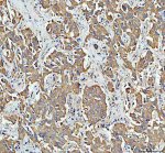 BCKDH E2 Antibody staining of human liver cancer by IHC. Immunohistochemistry of FFPE human liver cancer sections using the BCKDH E2 Antibody at 2 ug/ml. Moderate-to-strong brown granular staining is distributed throughout the cytoplasm of many tumor cells, while nuclei are counterstained blue and remain predominantly negative. Staining intensity varies among individual cells but maintains a primarily cytoplasmic distribution consistent with mitochondrial DBT localization. Heat-mediated antigen retrieval was performed in pH 8 EDTA before antibody incubation. The observed staining demonstrates tissue detection of dihydrolipoamide branched-chain transacylase E2 with this DBT Antibody.