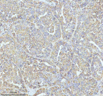 GCLC Antibody Liver Cancer IHC. Immunohistochemical staining of FFPE human liver carcinoma tissue using GCLC Antibody / Glutathione Biosynthesis Antibody demonstrates widespread cytoplasmic HRP-DAB brown staining throughout neoplastic hepatic cell populations. The staining pattern is consistent with expression of Glutamate-Cysteine Ligase Catalytic Subunit (GCLC), the catalytic component of the rate-limiting enzyme in glutathione biosynthesis and a central regulator of cellular antioxidant defense pathways. Diffuse immunoreactivity within tumor cells is consistent with the established role of GCLC in glutathione production, oxidative stress adaptation, detoxification mechanisms, and metabolic homeostasis. The observed staining demonstrates the utility of this antibody for studies of redox biology, cancer metabolism, oxidative stress signaling, antioxidant defense pathways, and glutathione-dependent cellular protection mechanisms. HIER: EDTA buffer, pH 8.0.