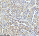 GCLC Antibody Liver Cancer IHC. Immunohistochemical staining of FFPE human liver carcinoma tissue using GCLC Antibody / Glutathione Biosynthesis Antibody demonstrates moderate to strong cytoplasmic HRP-DAB brown staining throughout malignant hepatic cell populations arranged in trabecular and glandular-like growth patterns. The staining profile is consistent with expression of Glutamate-Cysteine Ligase Catalytic Subunit (GCLC), the catalytic component of the rate-limiting enzyme in glutathione biosynthesis and a critical regulator of cellular antioxidant defense mechanisms. Prominent cytoplasmic immunoreactivity within neoplastic cells is consistent with the established role of GCLC in glutathione production, oxidative stress adaptation, xenobiotic detoxification, and metabolic homeostasis. The observed staining demonstrates the utility of this antibody for studies of redox biology, antioxidant defense pathways, cancer metabolism, oxidative stress signaling, and glutathione-dependent cellular protection mechanisms. HIER: EDTA buffer, pH 8.0.
