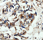 Immunofluorescent staining of HPGD using anti-HPGD antibody (green) and anti-Beta Tubulin antibody (red). HPGD was detected in an immunocytochemical section of cells. Enzyme antigen retrieval was performed using IHC enzyme antigen retrieval reagent for 15 mins. The cells were blocked with 10% goat serum. And then incubated with 5 ug/ml rabbit anti-HPGD antibody and mouse anti-Beta Tubulin antibody overnight at 4oC. DyLight 488 Conjugated Goat Anti-Rabbit IgG and Cy3 Conjugated Goat Anti-Mouse IgG were used as secondary antibody at 1:500 dilution and incubated for 30 minutes at 37oC. Visualize using a fluorescence microscope and filter sets appropriate for the label used.