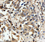 Immunohistochemical staining of HPGD using anti-HPGD antibody. HPGD was detected in a paraffin-embedded section of human lung cancer tissue. Heat mediated antigen retrieval was performed in EDTA buffer (pH 8.0, epitope retrieval solution). The tissue section was blocked with 10% goat serum. The tissue section was then incubated with 2 ug/ml rabbit anti-HPGD antibody overnight at 4oC. Peroxidase Conjugated Goat Anti-rabbit IgG was used as secondary antibody and incubated for 30 minutes at 37oC. The tissue section was developed using an HRP secondary and DAB substrate.