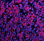 Immunofluorescent staining of HPGD using anti-HPGD antibody (red). HPGD was detected in a paraffin-embedded section of human breast cancer tissue. Heat mediated antigen retrieval was performed in EDTA buffer (pH 8.0, epitope retrieval solution). The tissue section was blocked with 10% goat serum. The tissue section was then incubated with 5 ug/ml rabbit anti-HPGD antibody overnight at 4oC. Cy3 Conjugated Goat Anti-Rabbit IgG was used as secondary antibody at 1:500 dilution and incubated for 30 minutes at 37oC. The section was counterstained with DAPI nuclear stain (blue). Visualize using a fluorescence microscope and filter sets appropriate for the label used.