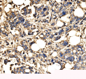 Immunohistochemical staining of FFPE human breast cancer tissue with SRP72 antibody, HRP-secondary and DAB substrate. HIER: boil tissue sections in pH8 EDTA for 20 min and allow to cool before testing.