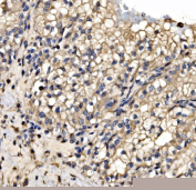 Immunohistochemical staining of FFPE human renal cancer tissue with SRP72 antibody, HRP-secondary and DAB substrate. HIER: boil tissue sections in pH8 EDTA for 20 min and allow to cool before testing.