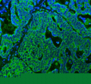 Immunofluorescent staining of FFPE human ovarian cancer tissue with SUCLG2 antibody (green) and DAPI nuclear stain (blue). HIER: steam section in pH8 EDTA buffer for 20 min.